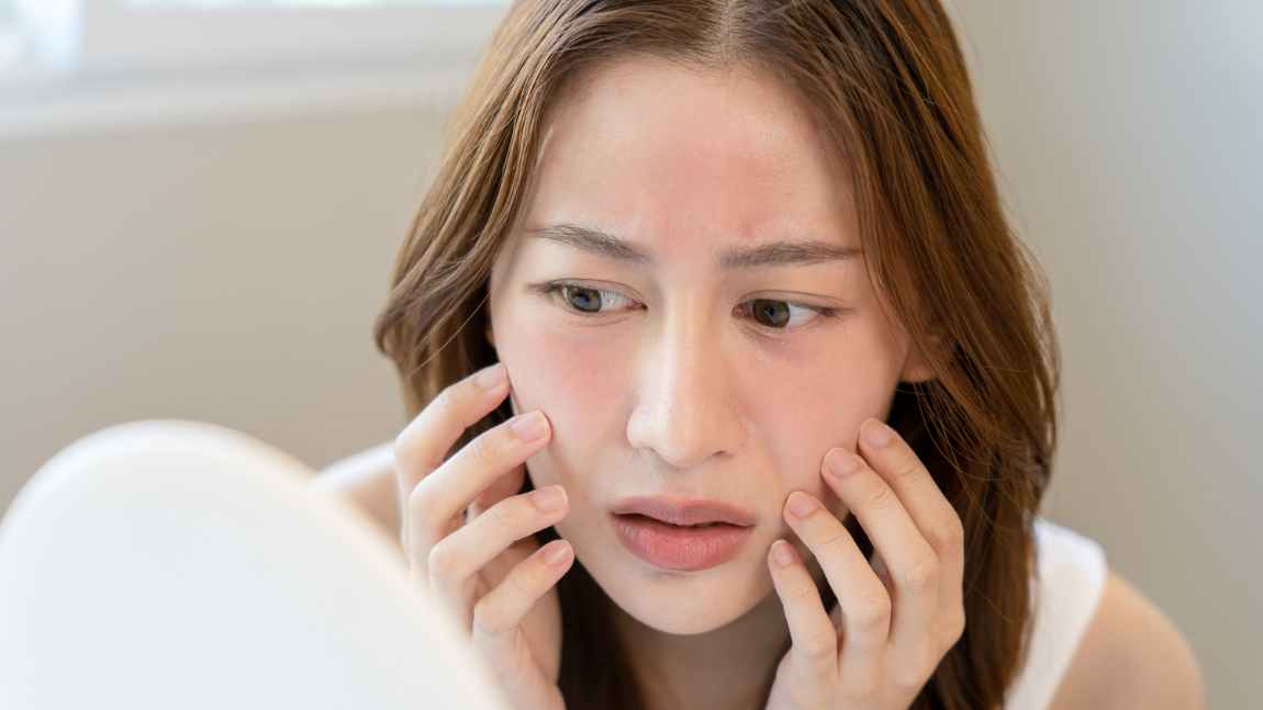 Kaip kovoti su odos paraudimu: patarimai jautrią odą turintiems žmonėms